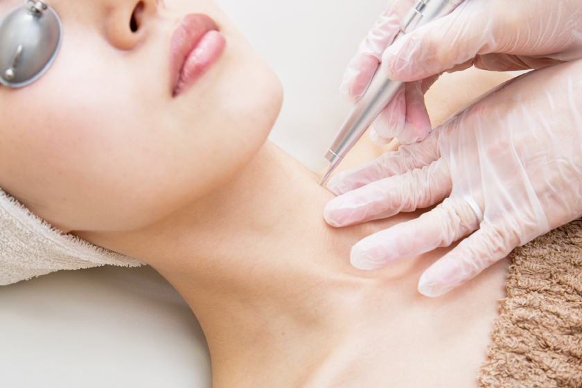 炭酸ガスレーザー（CO2レーザー）