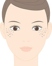 後天性真皮メラノサイトーシス（ADM）