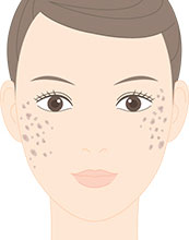 老人性色素斑（老人性イボ・老人性疣贅・脂漏性角化症）