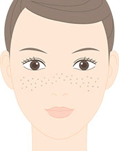 そばかす（雀卵斑）