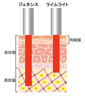 「ジェネシス」というレーザー治療と「ライムライト」