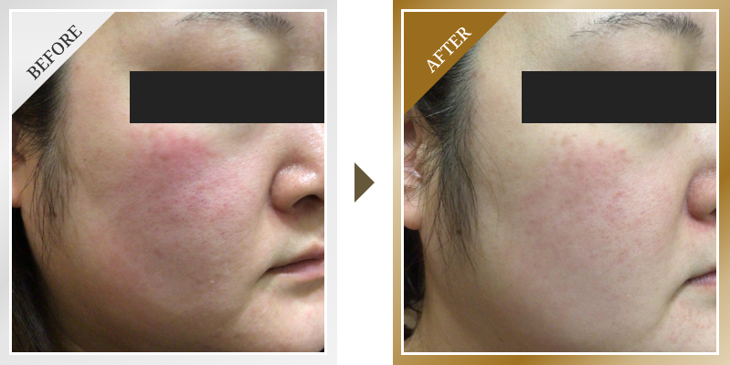 ジェネシス症例写真　赤み・毛穴にお悩みの症例