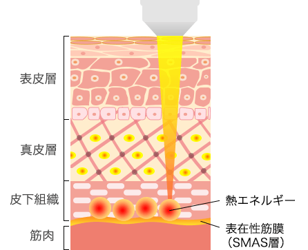 たるみの原因であるSMAS層に働きかける