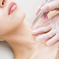 炭酸ガスレーザー（CO2レーザー）