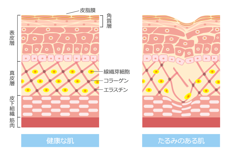 健康な肌とたるみのある肌
